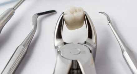 Why You May Need a Tooth Extraction