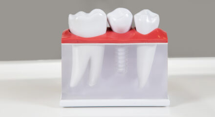Dentures vs. Dental Implants vs. Real Teeth