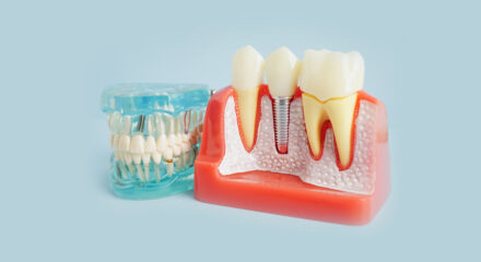 The Dental Implant Process