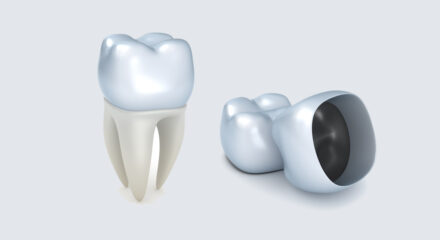 5 Reasons Why You Will Love CEREC®️ Dental Crowns