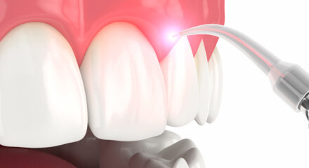 What are the Advantages of Laser Treatment?