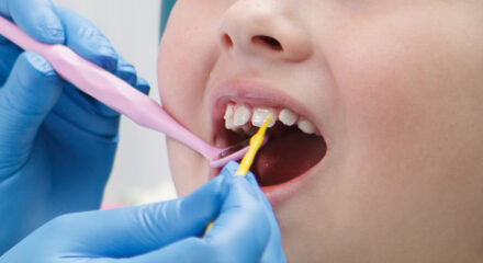 Benefits, Side Effects, and Recommendations of Fluoride Treatment