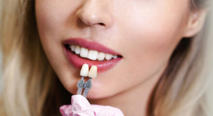 Dental Veneers 101: What You Need to Know Before Getting Them