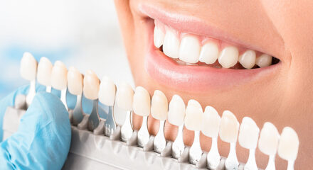 What You Need to Know About Dental Veneers