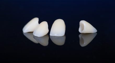 Is a CEREC Crown Right for You? Morristown Dentists Weigh In