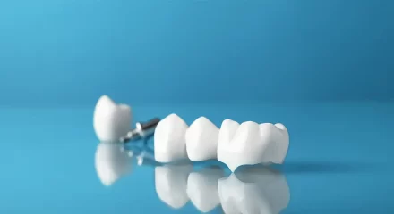 Thinking About CEREC Crowns? Here’s What You Must Know First